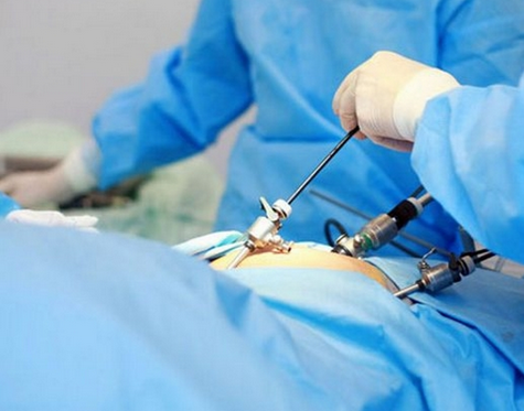 What are the Benefits of Laparoscopic Surgery?
