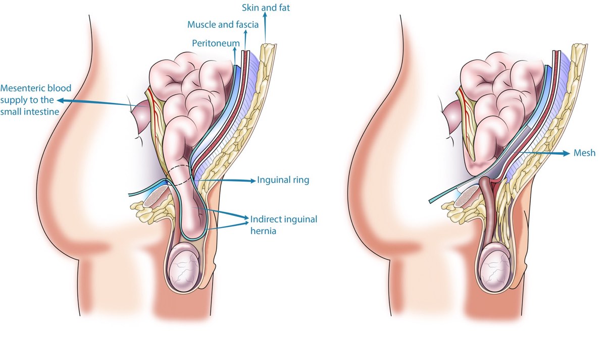 Hernia repair surgery
