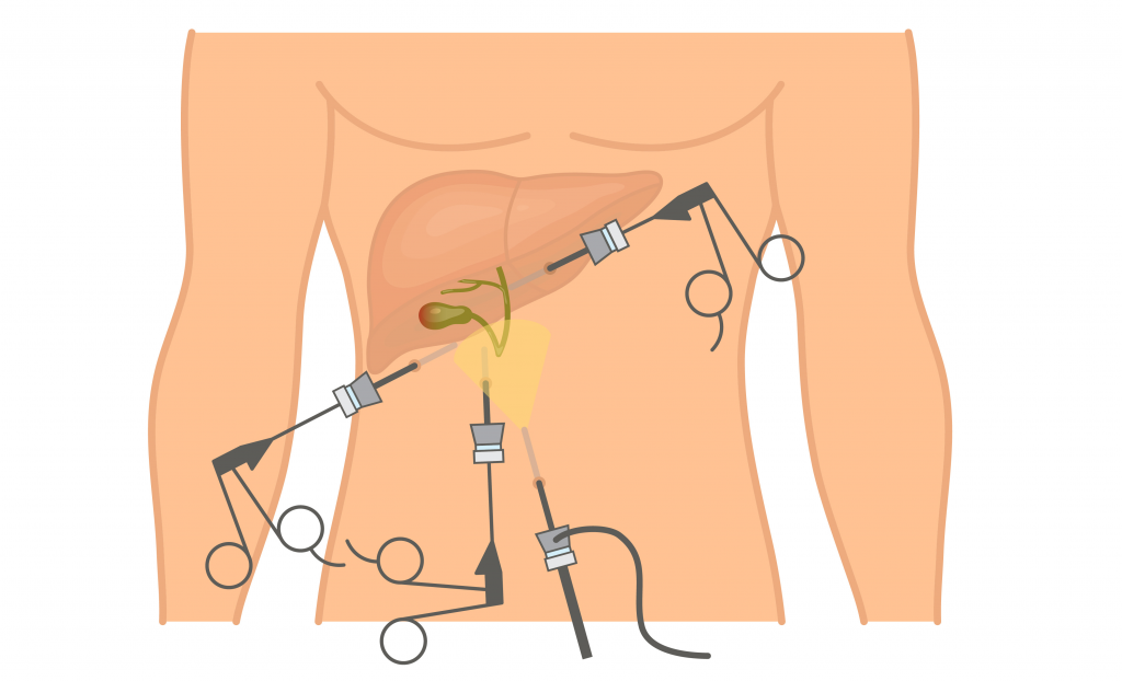 Laparoscopic cholecystectomy Gallbladder stones